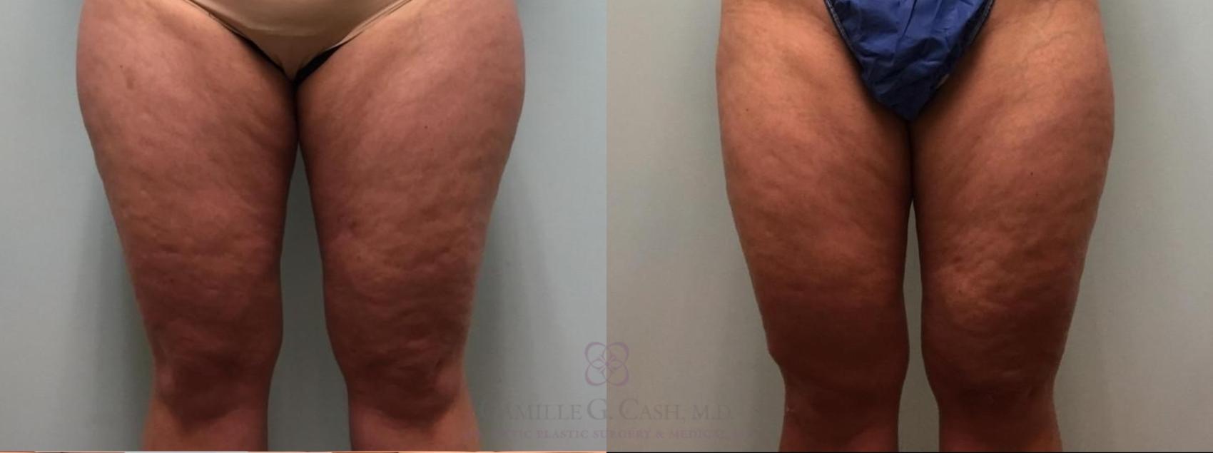 Before & After Liposuction Case 526 Front View in Houston, TX