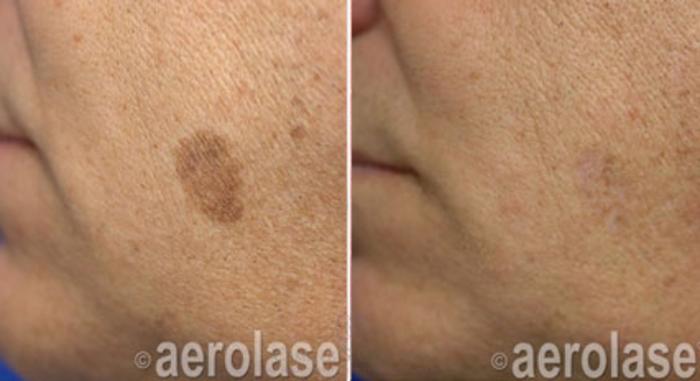 Before & After Aerolase Case 201 View #1 View in Houston, TX