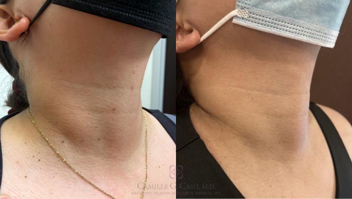Before & After Aerolase Case 467 Left Oblique View in Houston, TX
