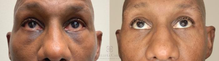 Before & After Aerolase Case 666 Front View in Houston, TX