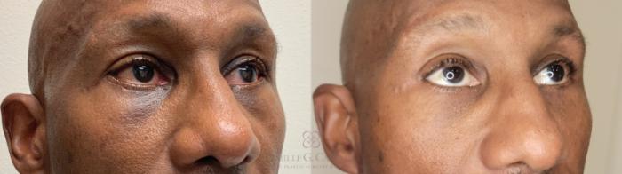 Before & After Aerolase Case 666 Right Oblique View in Houston, TX