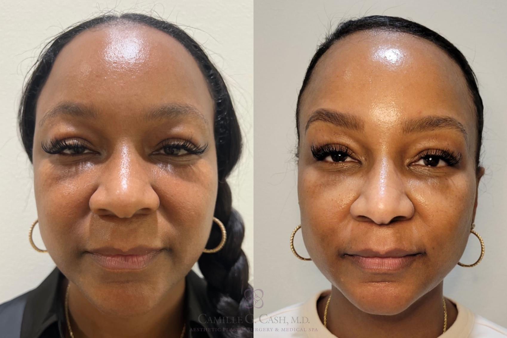 Before & After Aerolase Case 684 Front View in Houston, TX