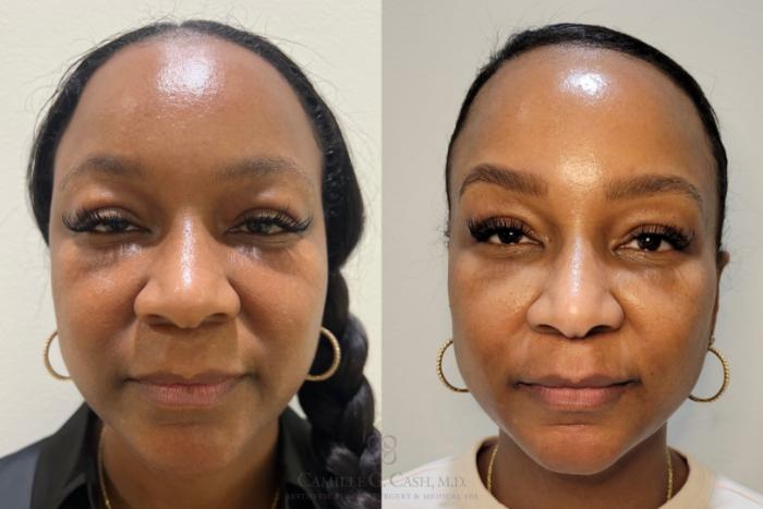 Before & After Aerolase Case 684 Front View in Houston, TX