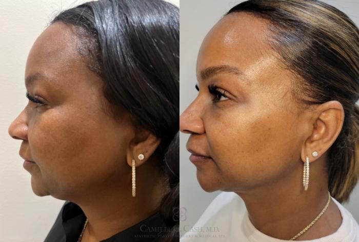 Before & After Aerolase Case 684 Left Side View in Houston, TX