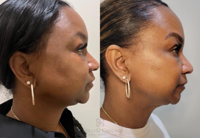 Before & After Aerolase Case 684 Right Side View in Houston, TX
