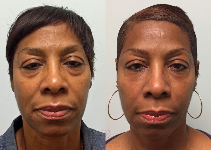 Before & After ALMI (Autologous Lipocyte Micronized Injection) Case 202 View #1 View in Houston, TX