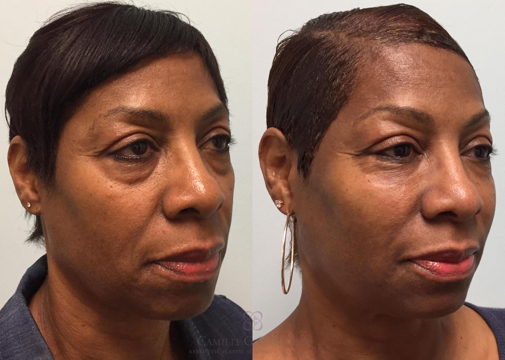 Before & After ALMI (Autologous Lipocyte Micronized Injection) Case 202 View #2 View in Houston, TX