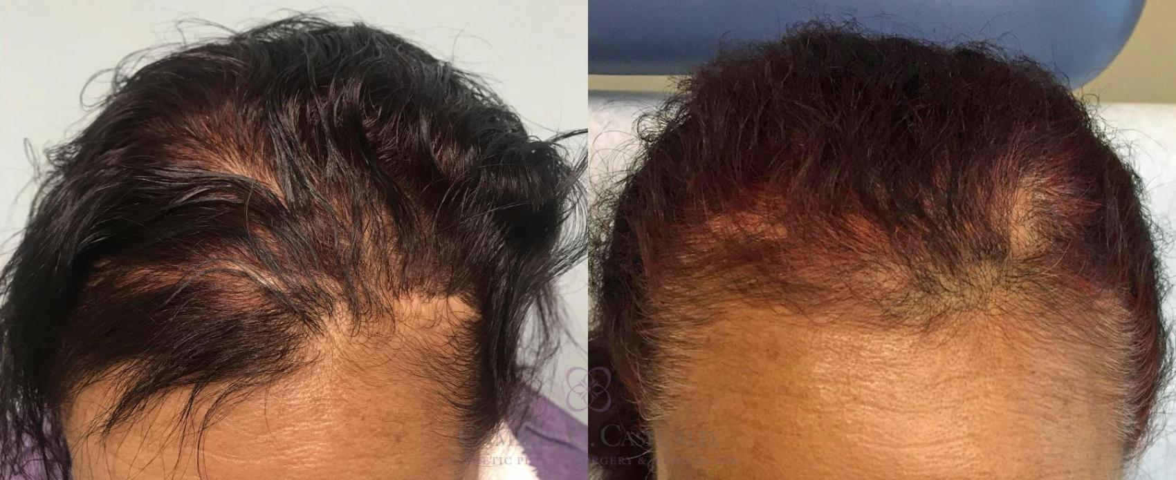 Before & After ALMI (Autologous Lipocyte Micronized Injection) Case 222 View #1 View in Houston, TX