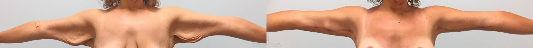 Before & After Arm Lift Case 317 View #1 View in Houston, TX