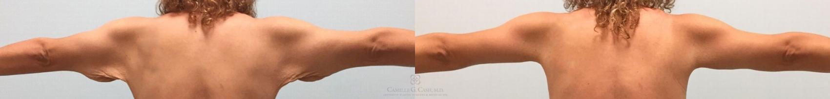 Before & After Arm Lift Case 317 View #2 View in Houston, TX