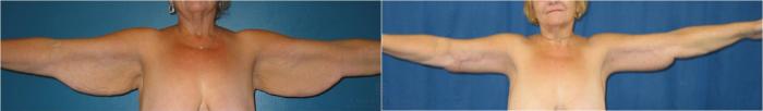 Before & After Arm Lift Case 34 View #1 View in Houston, TX