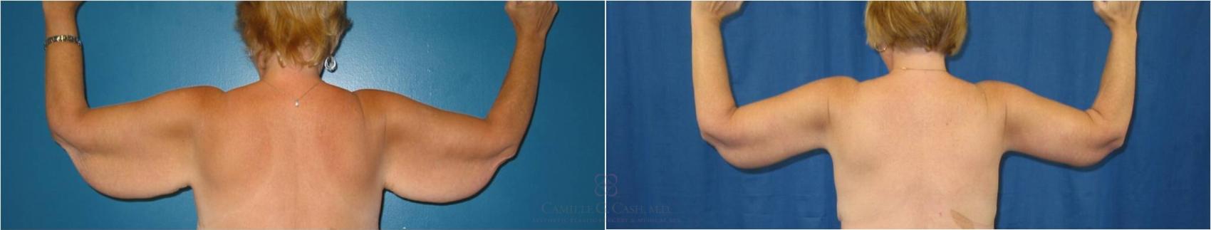 Before & After Arm Lift Case 34 View #2 View in Houston, TX