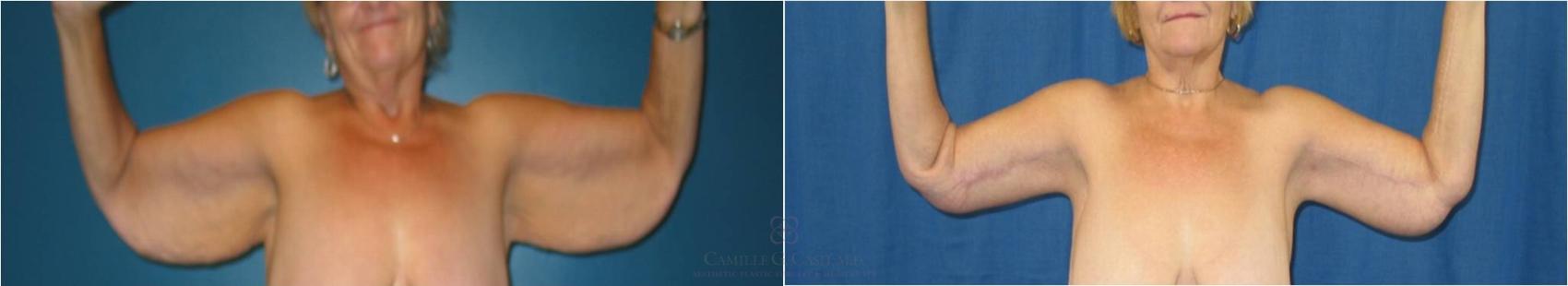 Before & After Arm Lift Case 34 View #3 View in Houston, TX