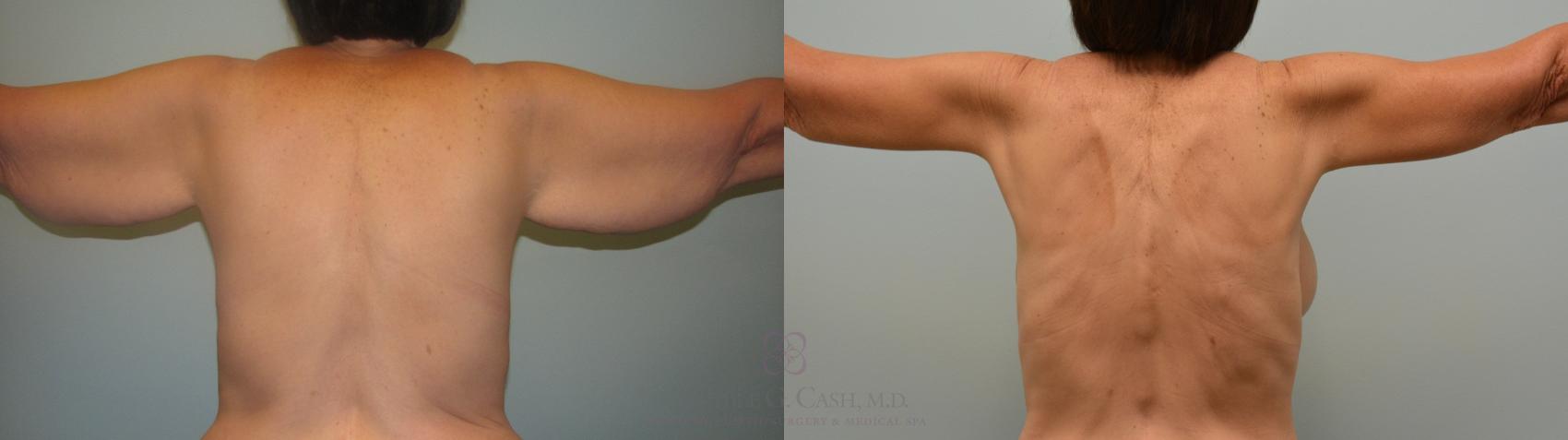 Before & After Arm Lift Case 458 Back View in Houston, TX