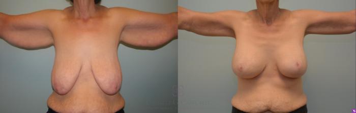 Before & After Arm Lift Case 458 Front View in Houston, TX
