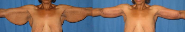 Before & After Arm Lift Case 63 View #1 View in Houston, TX