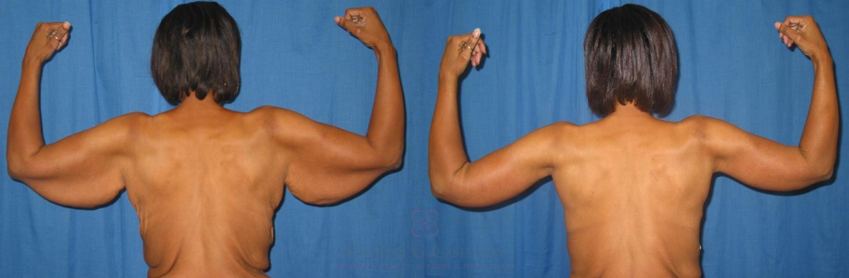 Before & After Arm Lift Case 63 View #2 View in Houston, TX
