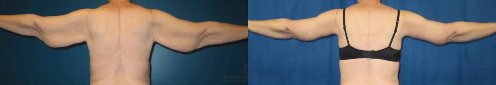 Before & After Arm Lift Case 86 View #1 View in Houston, TX