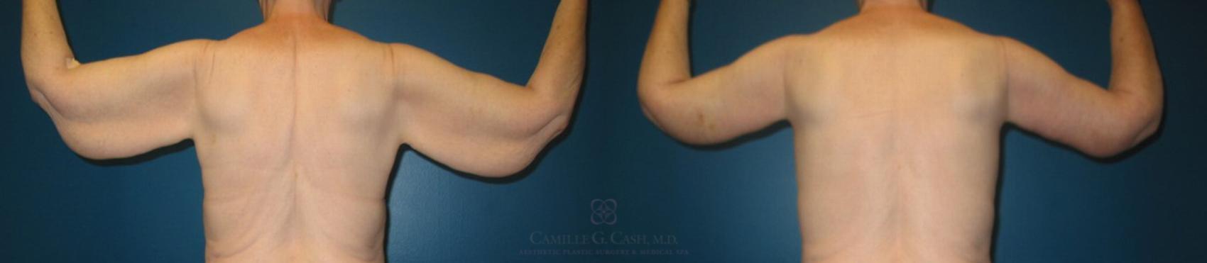 Before & After Arm Lift Case 86 View #2 View in Houston, TX