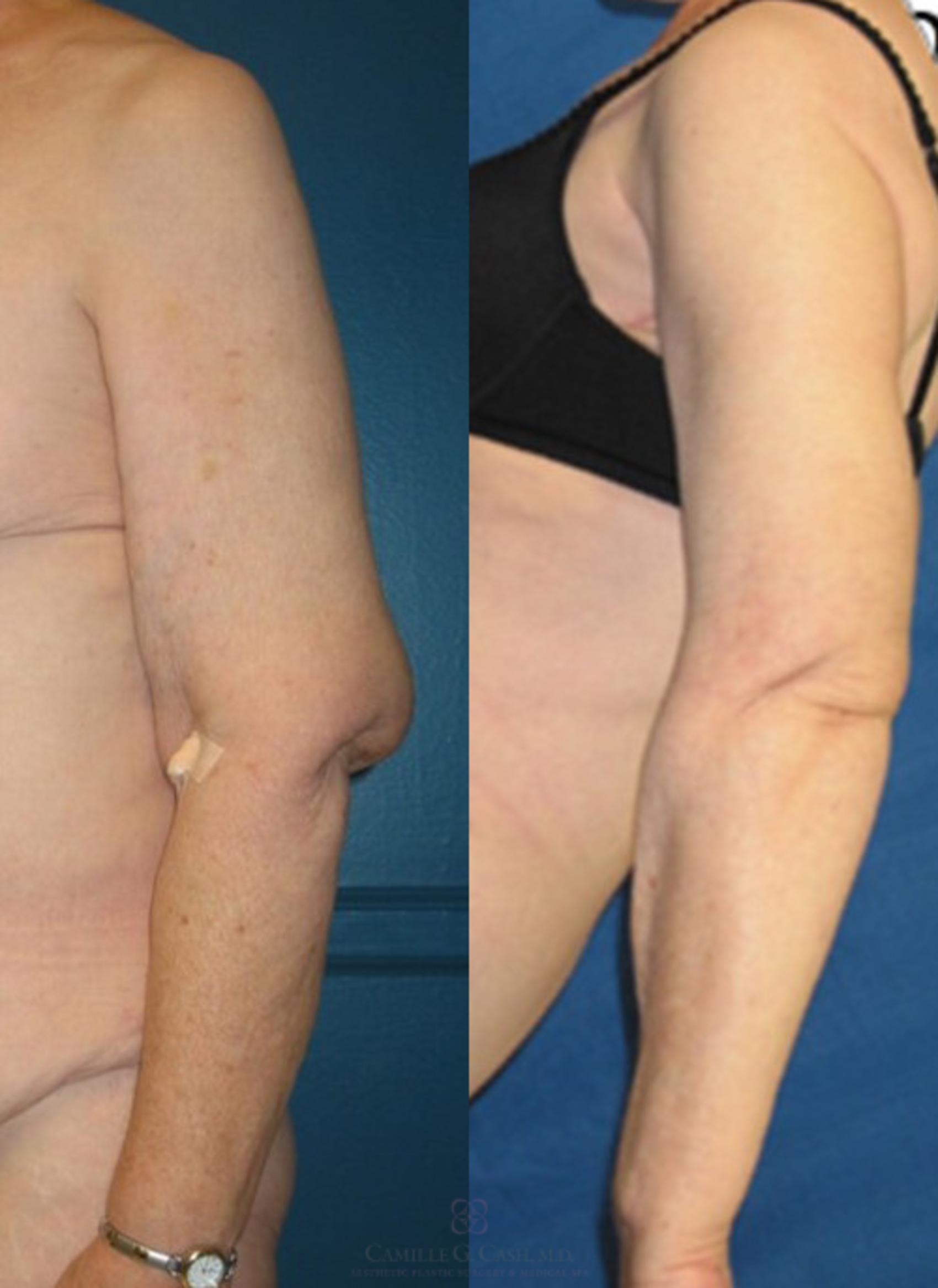 Before & After Arm Lift Case 86 View #3 View in Houston, TX