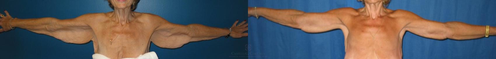 Before & After Arm Lift Case 87 View #3 View in Houston, TX