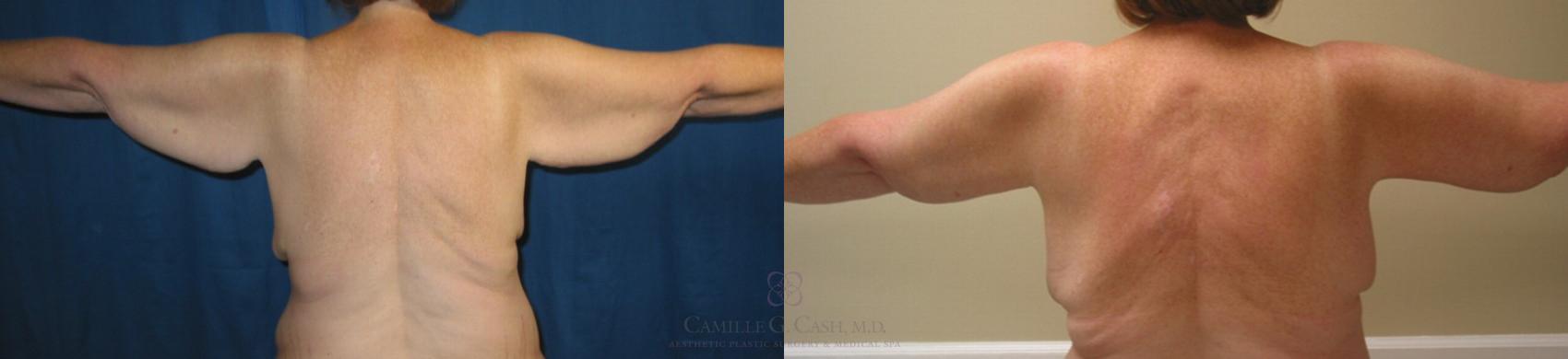 Before & After Arm Lift Case 95 View #1 View in Houston, TX