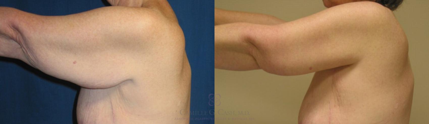 Before & After Arm Lift Case 95 View #2 View in Houston, TX