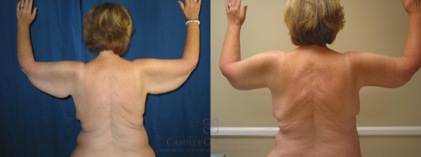 Before & After Arm Lift Case 95 View #3 View in Houston, TX