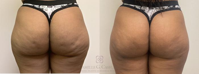Before & After Avéli Case 496 back view View in Houston, TX