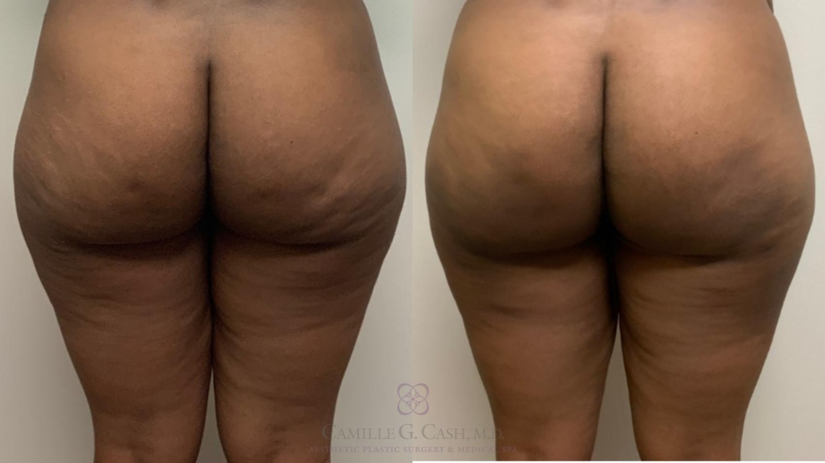 Before & After Avéli Case 496 back zoom View in Houston, TX