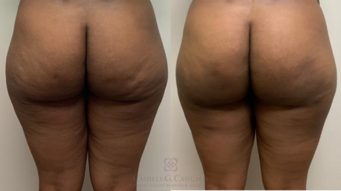 Before & After Avéli Case 496 back zoom View in Houston, TX