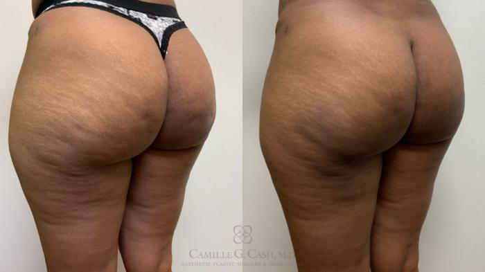 Before & After Avéli Case 496 Left Oblique View in Houston, TX
