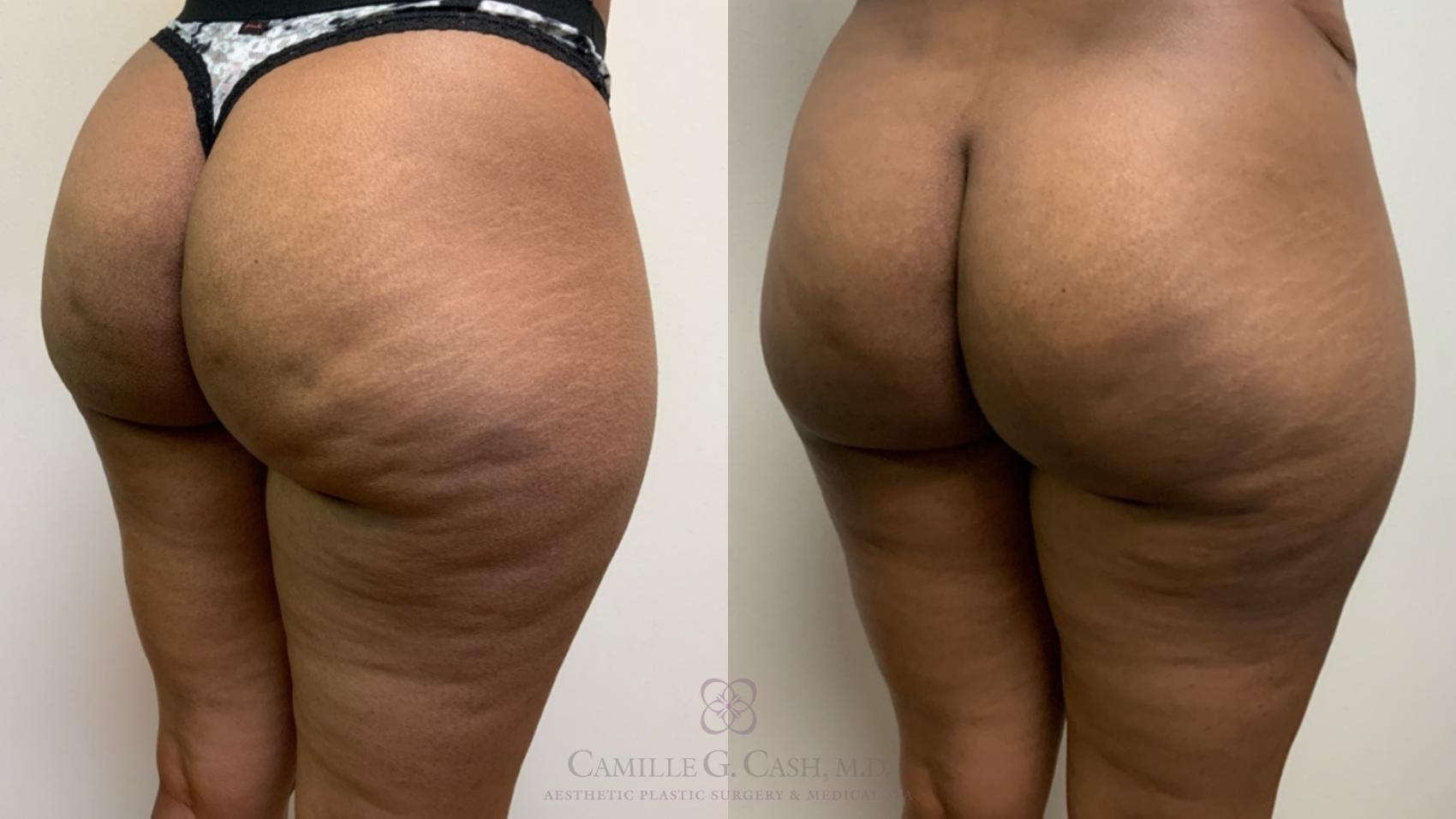Before & After Avéli Case 496 Right Oblique View in Houston, TX