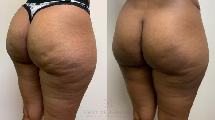 Before & After Avéli Case 496 Right Oblique View in Houston, TX
