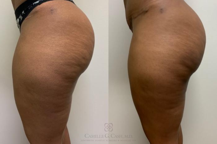 Before & After Avéli Case 496 Right Side View in Houston, TX