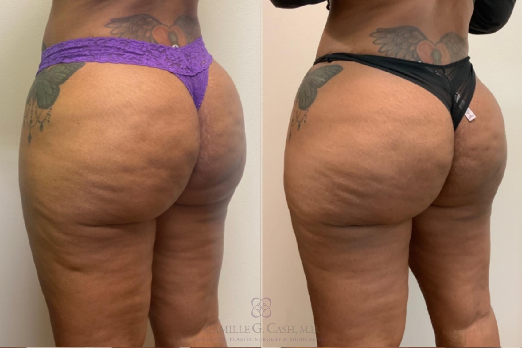 Before & After Avéli Case 497 6 mo left oblique View in Houston, TX