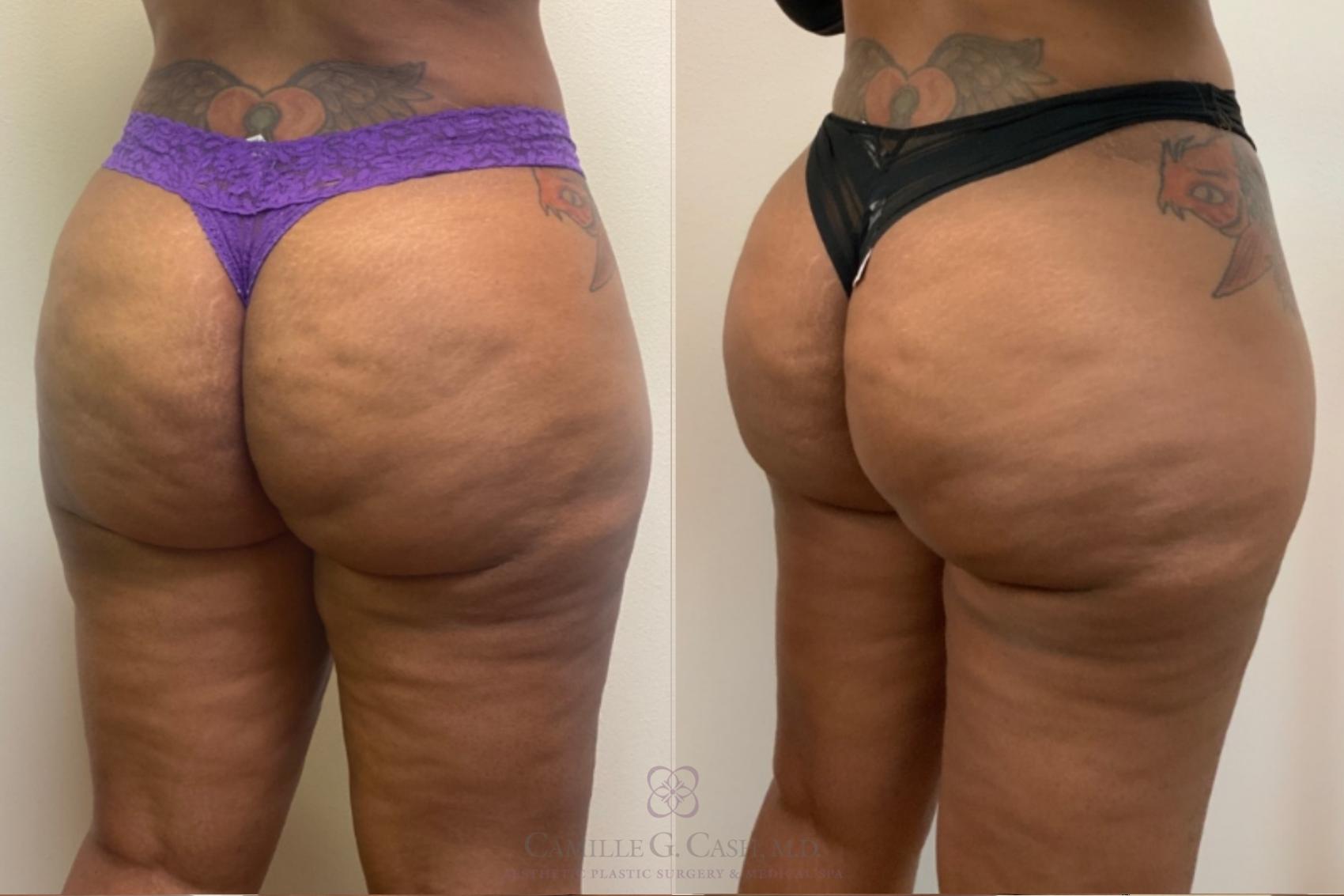 Before & After Avéli Case 497 6 month right oblique View in Houston, TX