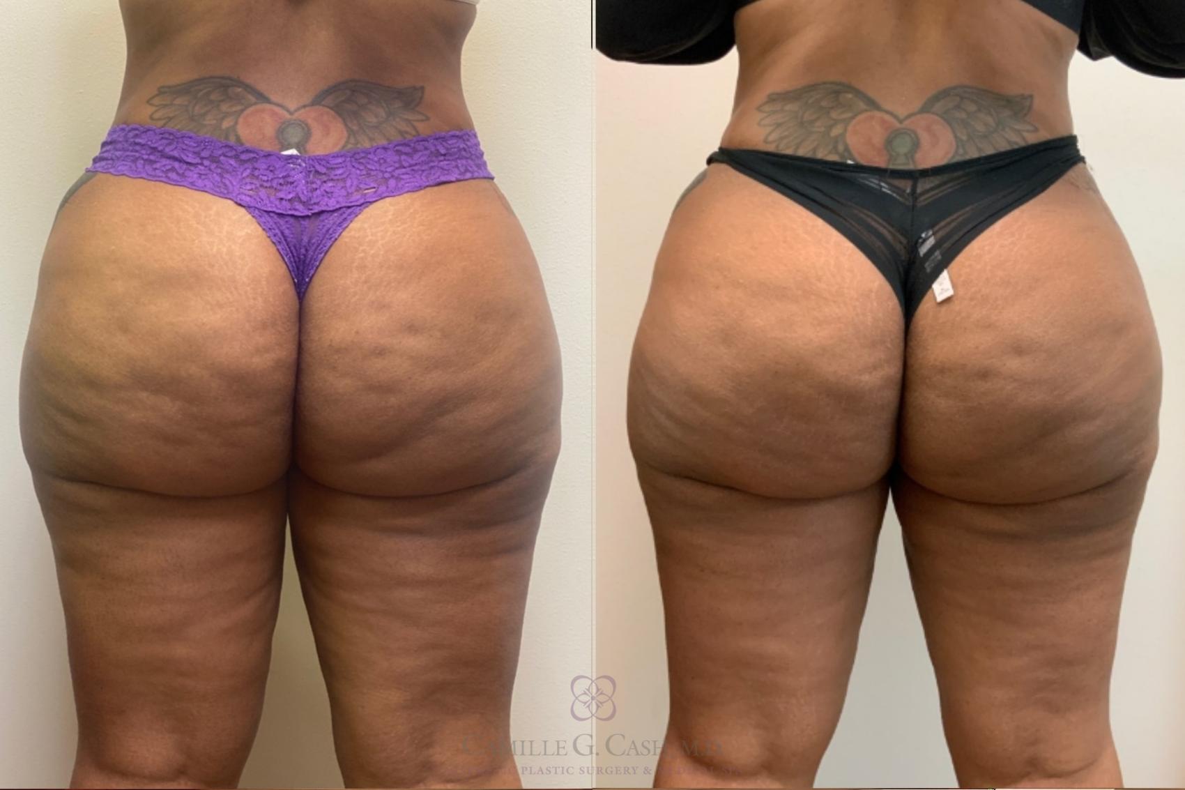 Before & After Avéli Case 497 back 6 months after View in Houston, TX
