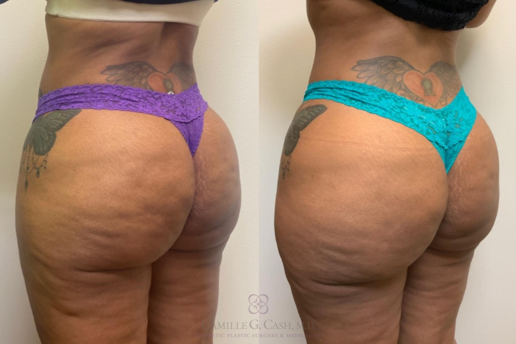 Before & After Avéli Case 497 Left Oblique View in Houston, TX