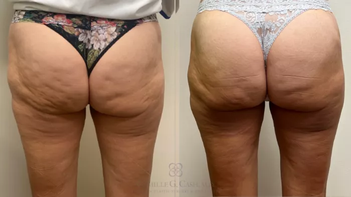 Cellulite Treatment, Dr. Lyle Back