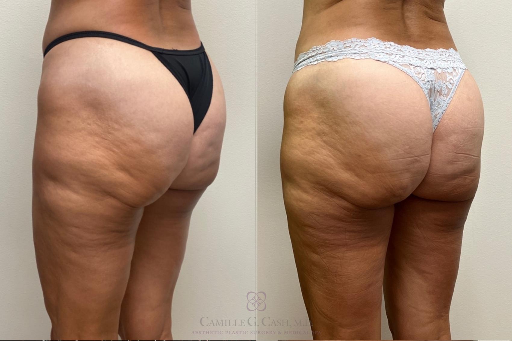 Before & After Avéli Case 527 Left Oblique View in Houston, TX