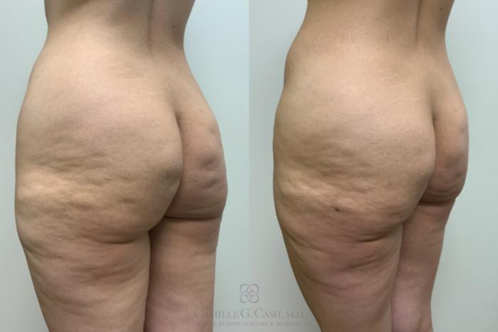 Before & After Avéli Case 619 Left Oblique View in Houston, TX