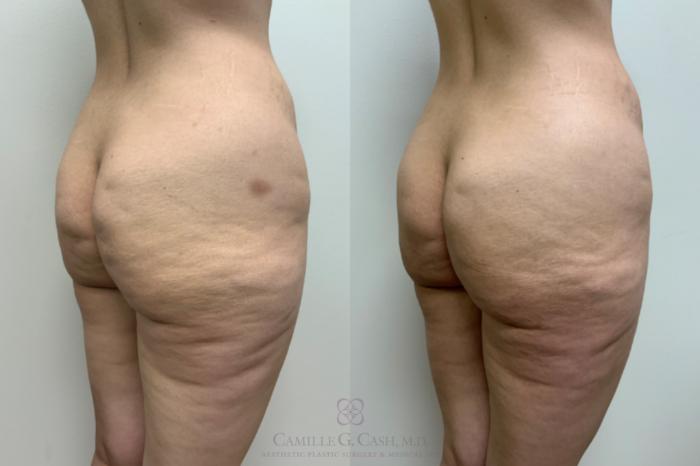 Before & After Avéli Case 619 Right Oblique View in Houston, TX