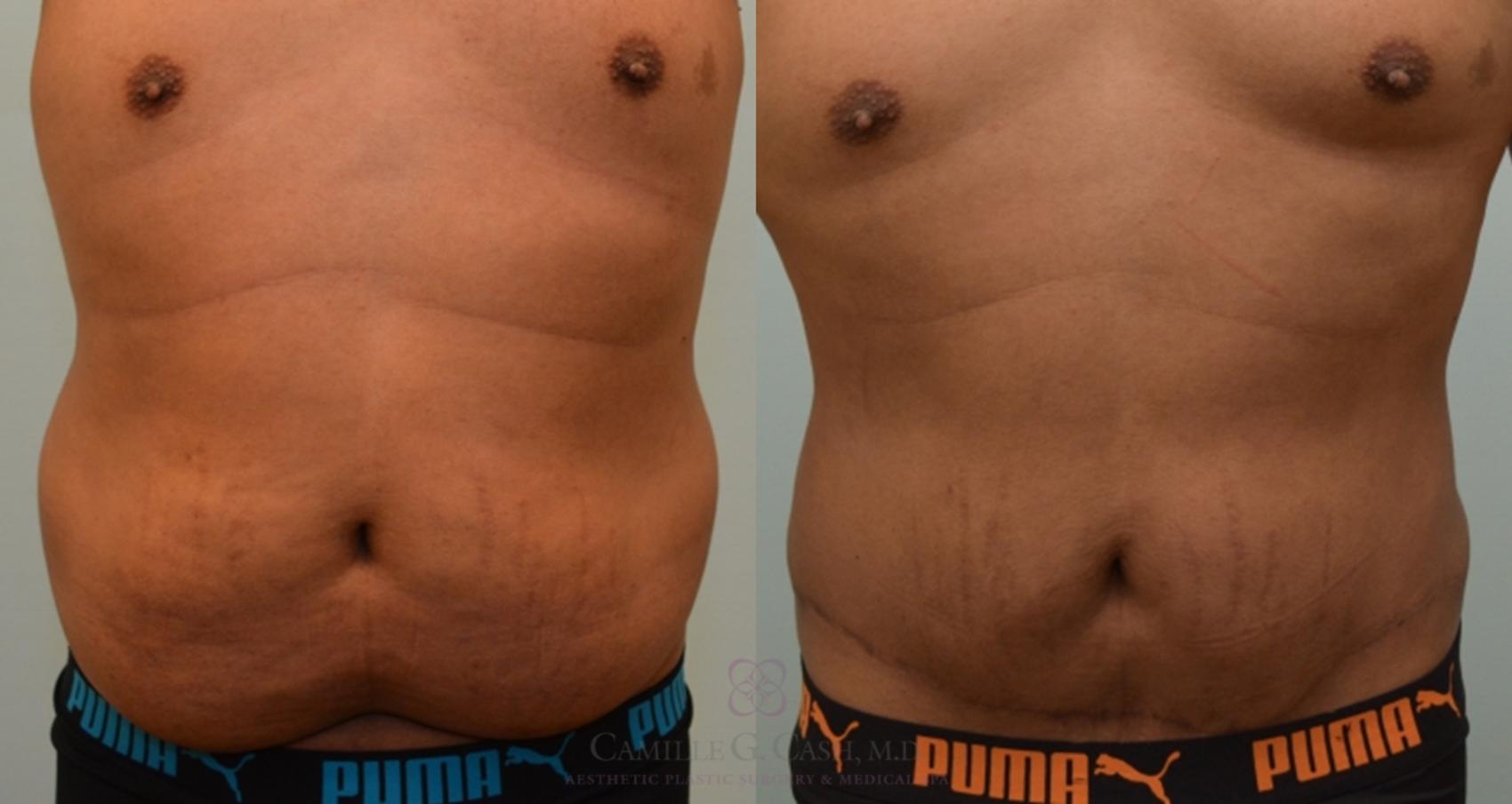 Before & After Body Contouring for Men Case 136 View #1 View in Houston, TX