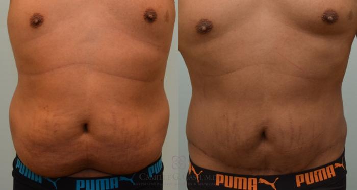 Before & After Body Contouring for Men Case 136 View #1 View in Houston, TX