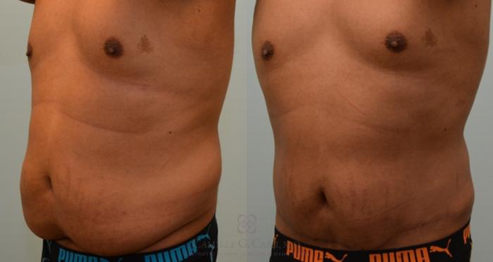 Before & After Body Contouring for Men Case 136 View #2 View in Houston, TX