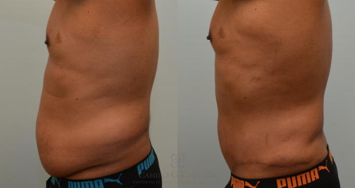 Before & After Body Contouring for Men Case 136 View #3 View in Houston, TX