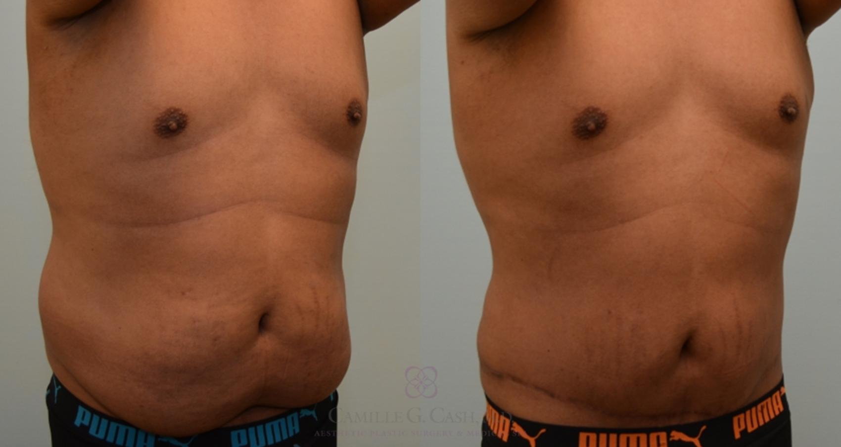 Before & After Body Contouring for Men Case 136 View #4 View in Houston, TX