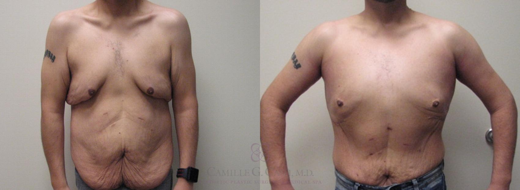Before & After Body Contouring for Men Case 154 View #1 View in Houston, TX