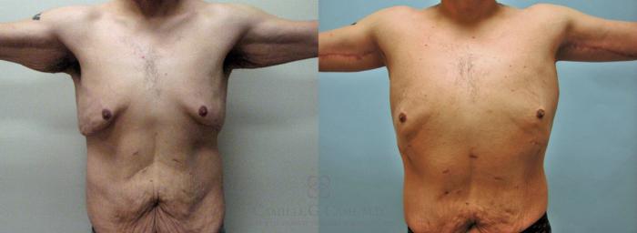 Before & After Body Contouring for Men Case 154 View #2 View in Houston, TX